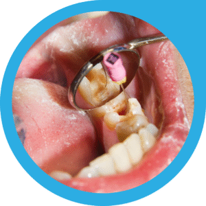 Affordable Root Canal Treatment in Howrah by experienced dentists with painless RCT procedure at budget-friendly cost