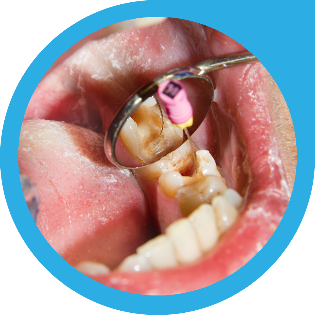 You are currently viewing Affordable Root Canal Treatment in Howrah – Quality Dental Care Within Your Budget