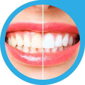 Read more about the article Teeth Whitening Near Chinar Park