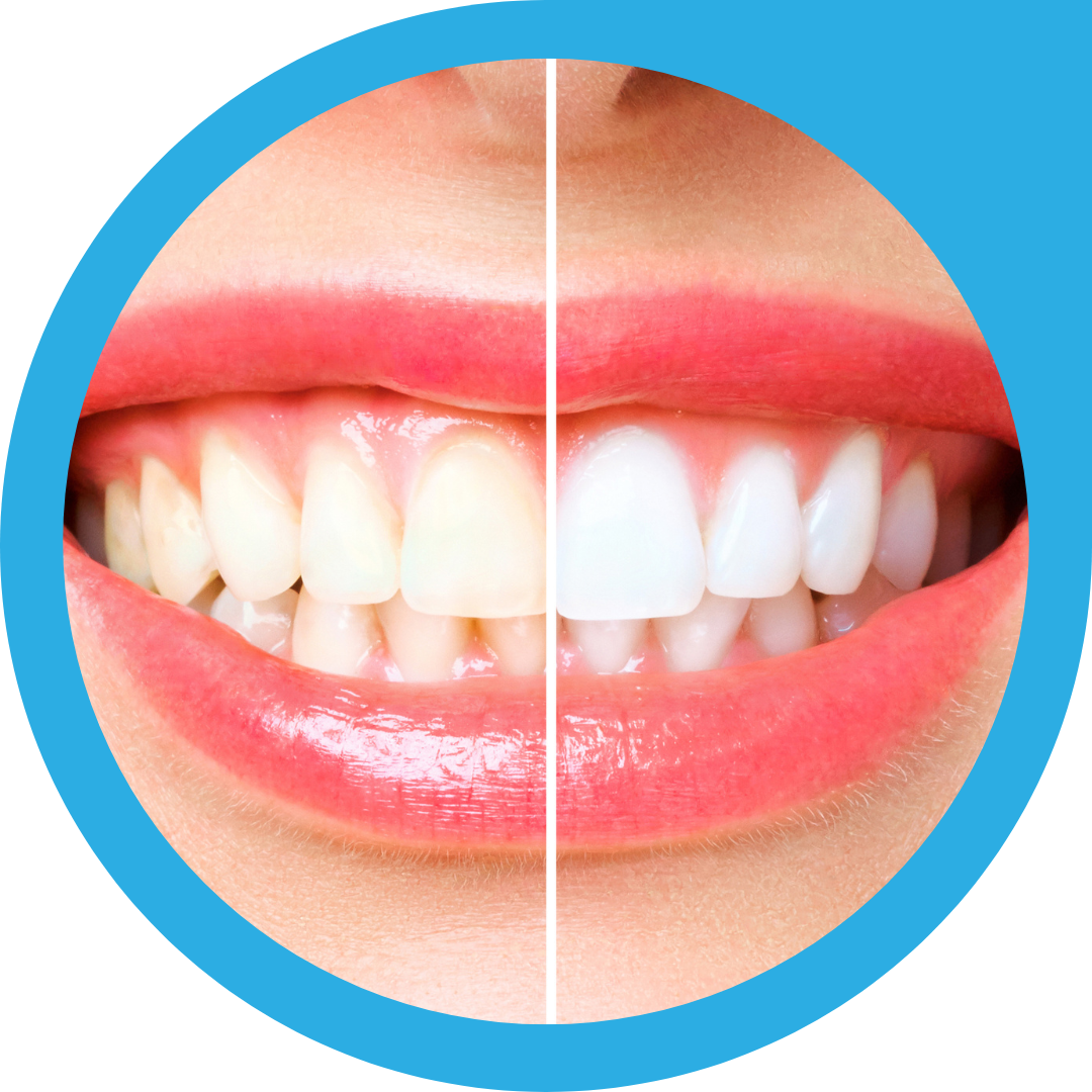 Read more about the article Teeth Whitening Near Chinar Park
