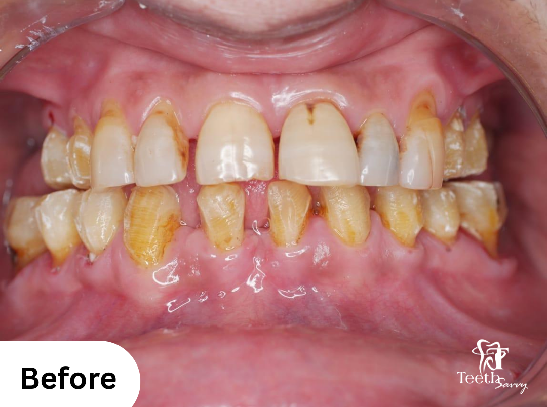 Before_full_mouth_rehabilitation