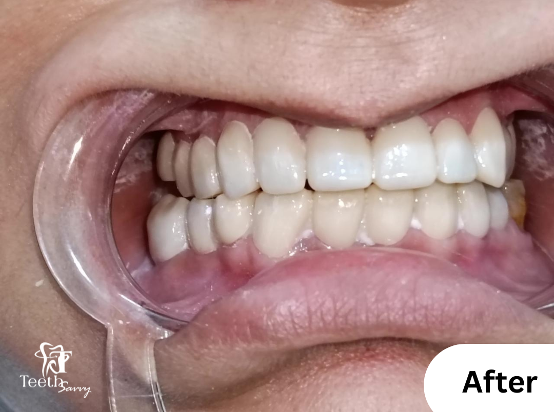 After_full_mouth_rehabilitation