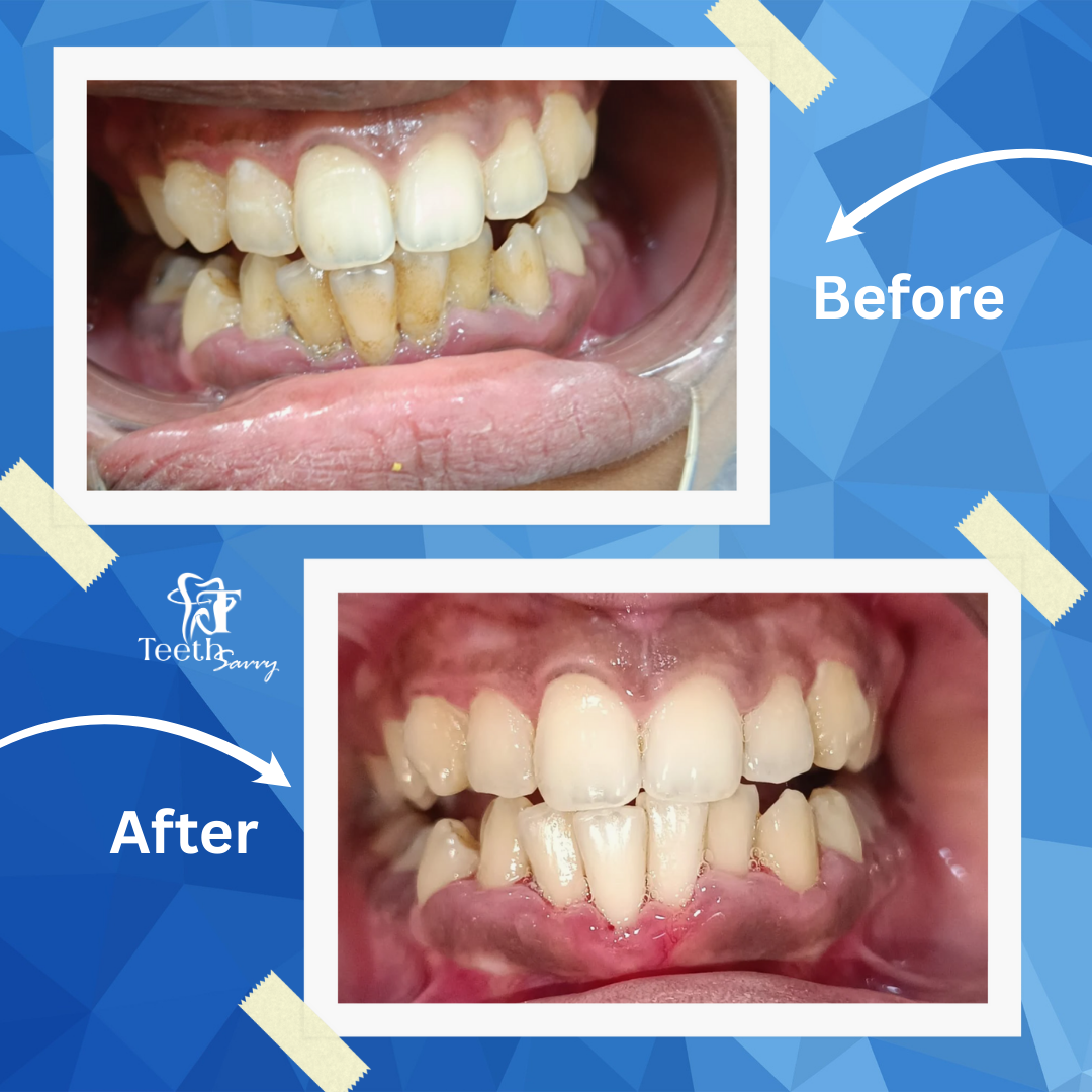 You are currently viewing Case Study: Scaling Treatment for Bad Breath & Bleeding Gums (29-year-old, Lake Town)