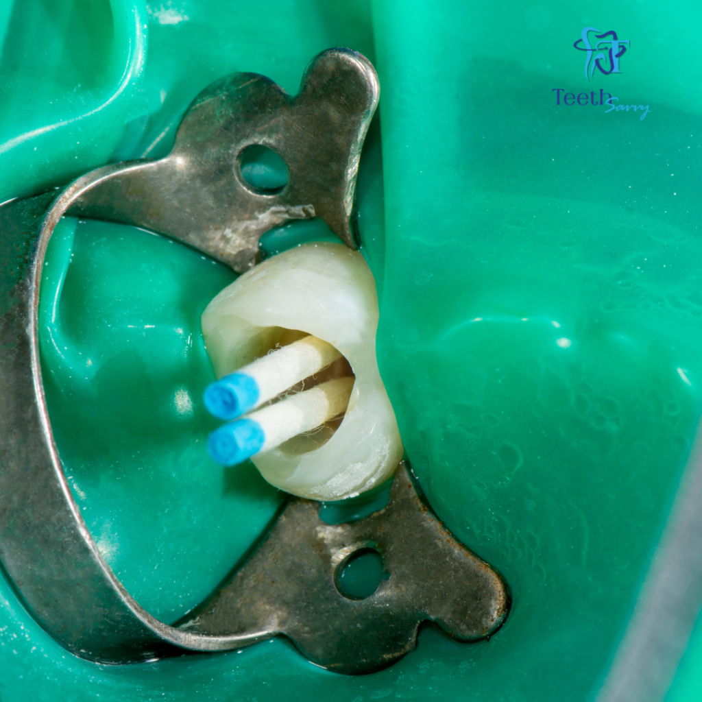 Painless root canal treatment in Laketown Kolkata showing removal of infected pulp and tooth restoration by expert dentist at TeethSavvy dental clinic for long-lasting relief from tooth pain and infection