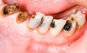 Read more about the article Early signs of cavities how best dental clinic near Newtown treats them