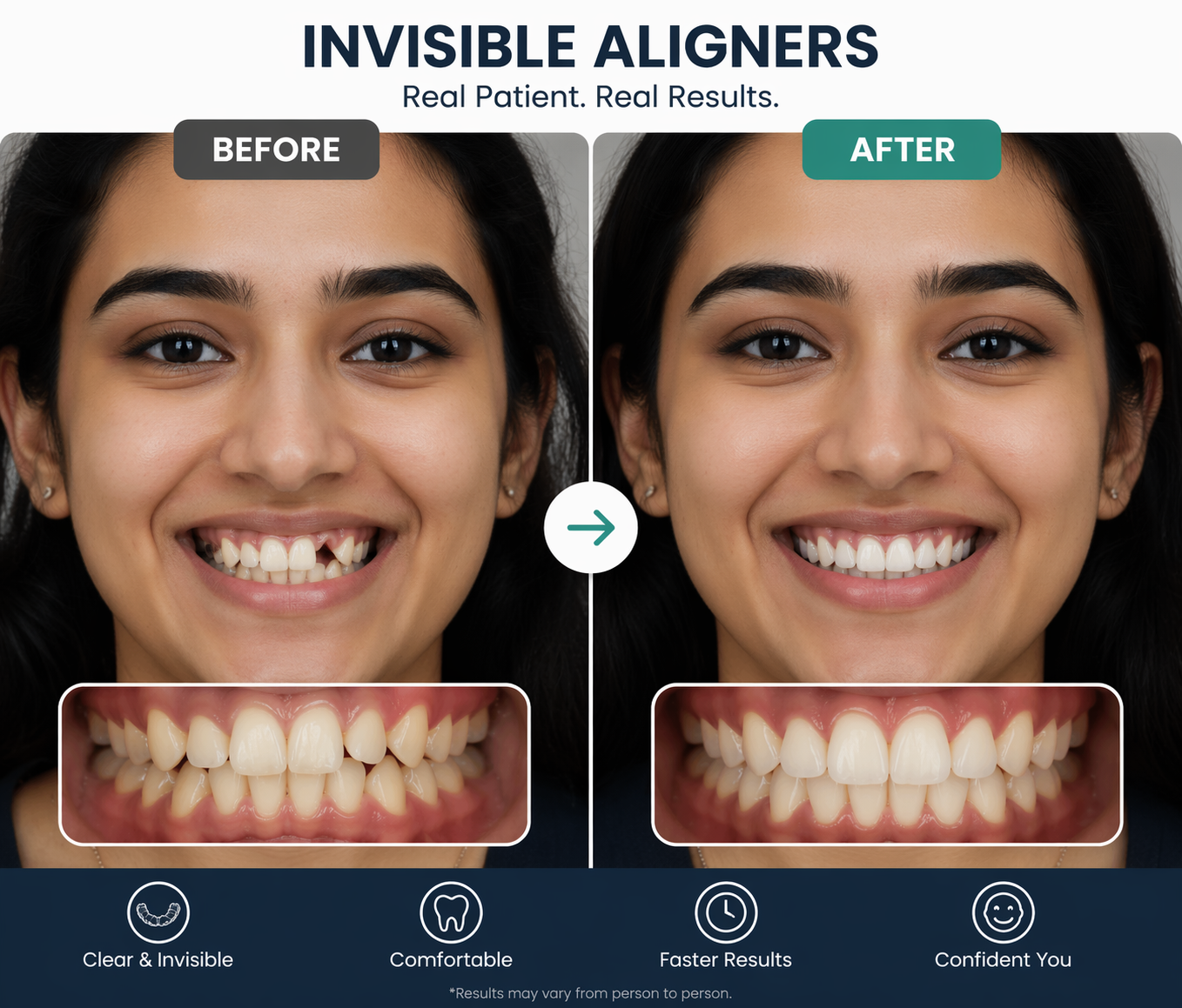 Before After Invisible Aligners