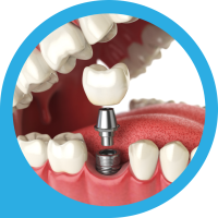 Dental Implant