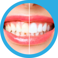 Teeth Whitening